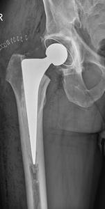 Thumb hofte ligge ap alloplastik xray2