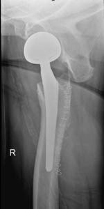 Thumb hofte ligge axial alloplstix xray