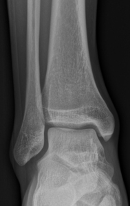 Thumb xray fodled skr%c3%a5