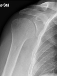 Thumb list thumb d4doc formularer upload 2014 11 skulderfrakturap 1