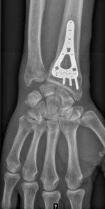 Thumb xray h%c3%a5ndled pa med kile og osteosyntese