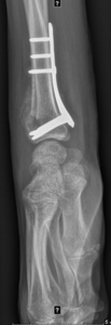 Thumb xray h%c3%a5ndled lat med kile og osteosyntese
